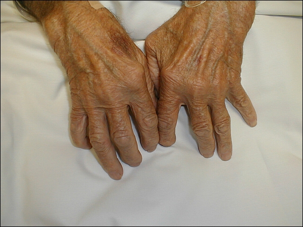 rheumatoid_arthritis_hand_deformitty.jpg