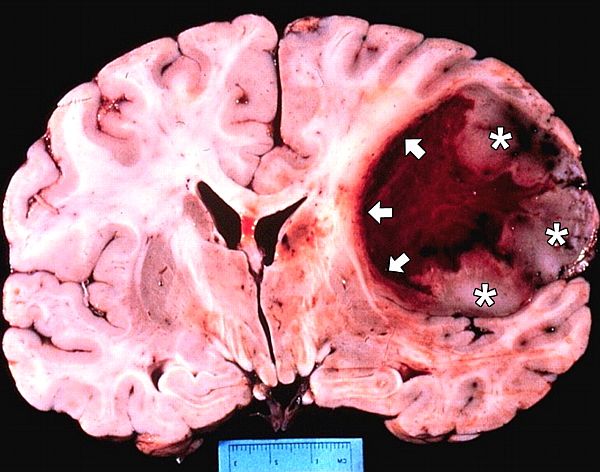 glioblastoma-multiforme-brain-tumor-vaccine.jpg