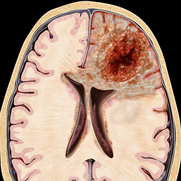 neuro_glioblastoma_x1v.jpg