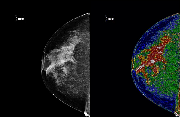 mammogram-zoom.jpg