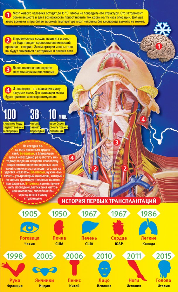 geektimes-head-transplantation-infographc.jpg