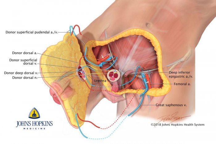 peniletransplant_diagram.jpg