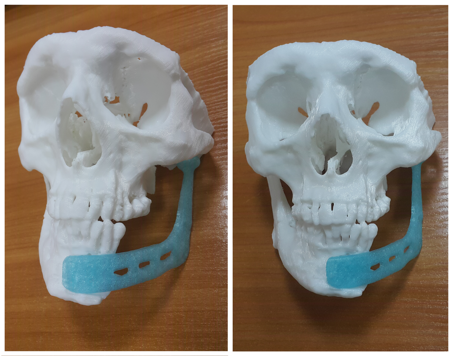 3д в медицине. Челюстно лицевые протезы. Лицевых и челюстных протезов. 3d печать в челюстно-лицевой хирургии. Челюстно-лицевая хирургия 3 д печать.